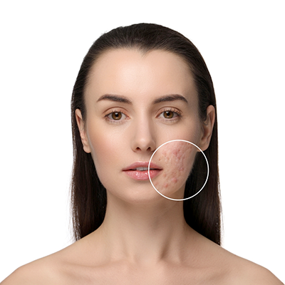 Acne & Acne Scars Treatment