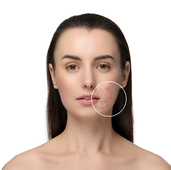 Acne & Acne Scars Treatment