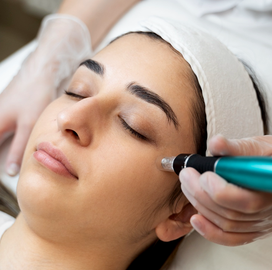 Microneedling Radiofrequency (MNRF)